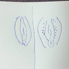 Wenn ich dann fertig bin juckt meine scheide, nicht innen! Kleine Blaschen An Vagina Hilfe Gesundheit Und Medizin Liebe Sex