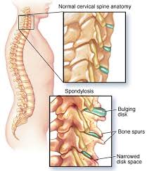What Is Spondylosis Spondylosis Treatments Causes Symptoms Cervical Spondylosis Spinal Stenosis Treatment Cervical Spinal Stenosis