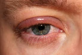 Eye Disorders Understanding The Causes Symptoms And Management The Pharmaceutical Journal