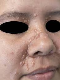 Femenina de 26 años,que acude a consulta refiriendo neoformaciones en cara  desde los 10 años con aparición paulatina.Dichas lesiones están presentes  en madre, abuela, tíos maternos,pero no en sus hermanos. -¿Cuál es