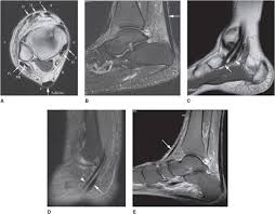 Ankle Mri Radiology Key