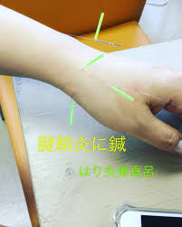 恵庭びわの葉温灸整体 はり灸樂真呂真澄 A Twitter 腱鞘炎に鍼 腱鞘炎 恵庭 はり灸樂真呂 ドケルバン病 産後腱鞘炎 産後ケア 仕事で腱鞘炎 えにわ 手首痛み 手首 女性鍼灸師