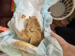 Stool is clay colored (gray stools) is a symptom in which there is not enough yellow, brown, or green color in the stool, meaning that there is not enough bile (from the liver and gall bladder) in the stool. Help Is This Clay Colored Poop Babycenter