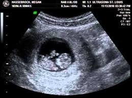 Expansion of the uterus, muscles and ligaments to accommodate a growing baby are all part of the growing bump. 3 Week Internal Ultrasound Novocom Top