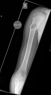 Fallen fragment sign