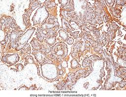 Pathology Outlines Hbme