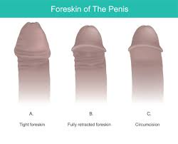 Image result for paraphimosis