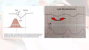 Image result for Early Deceleration