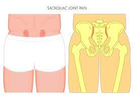 People with si joint dysfunction can experience pain and impaired function. Sacroiliac Joint Dysfunction Onz Spine