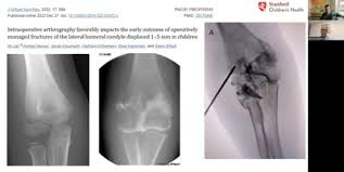 Image result for Lateral Condyle Fracture