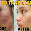 Ive been on diane 35 for a bit over a year now and for the past month ive been experiecing massive shedding/thinning. 1