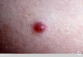Image result for Glomus tumor