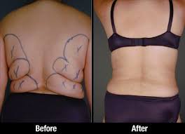 Back Lipo Before After 0010 In 2020 Workout Routine Plan Liposuction Lipo Before And After