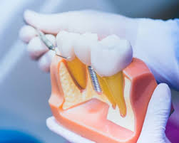 Dental Implant Procedure in Bronx, New York