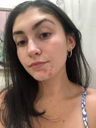 Because frizz is not your friend. Dennis Gross Blemish Solutions Acne Eliminating Gel Review Popsugar Beauty