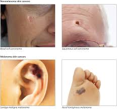Here are 10 more facts about prostate cancer. Figure 1 Types Of Skin Cancer The Surgeon General S Call To Action To Prevent Skin Cancer Ncbi Bookshelf