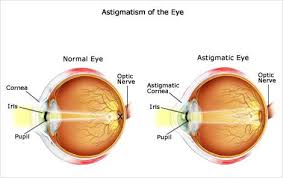 Ametropia Hyperopia Myopia Astigmatism Presbyopia Rayur Astigmatism Presbyopia Eye Exam