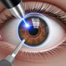 LASIK