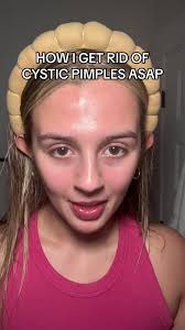 Get Rid of Cystic Acne Pimple Overnight