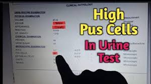 Microscopic Urinalysis: Test Procedure And Components Found In Urine