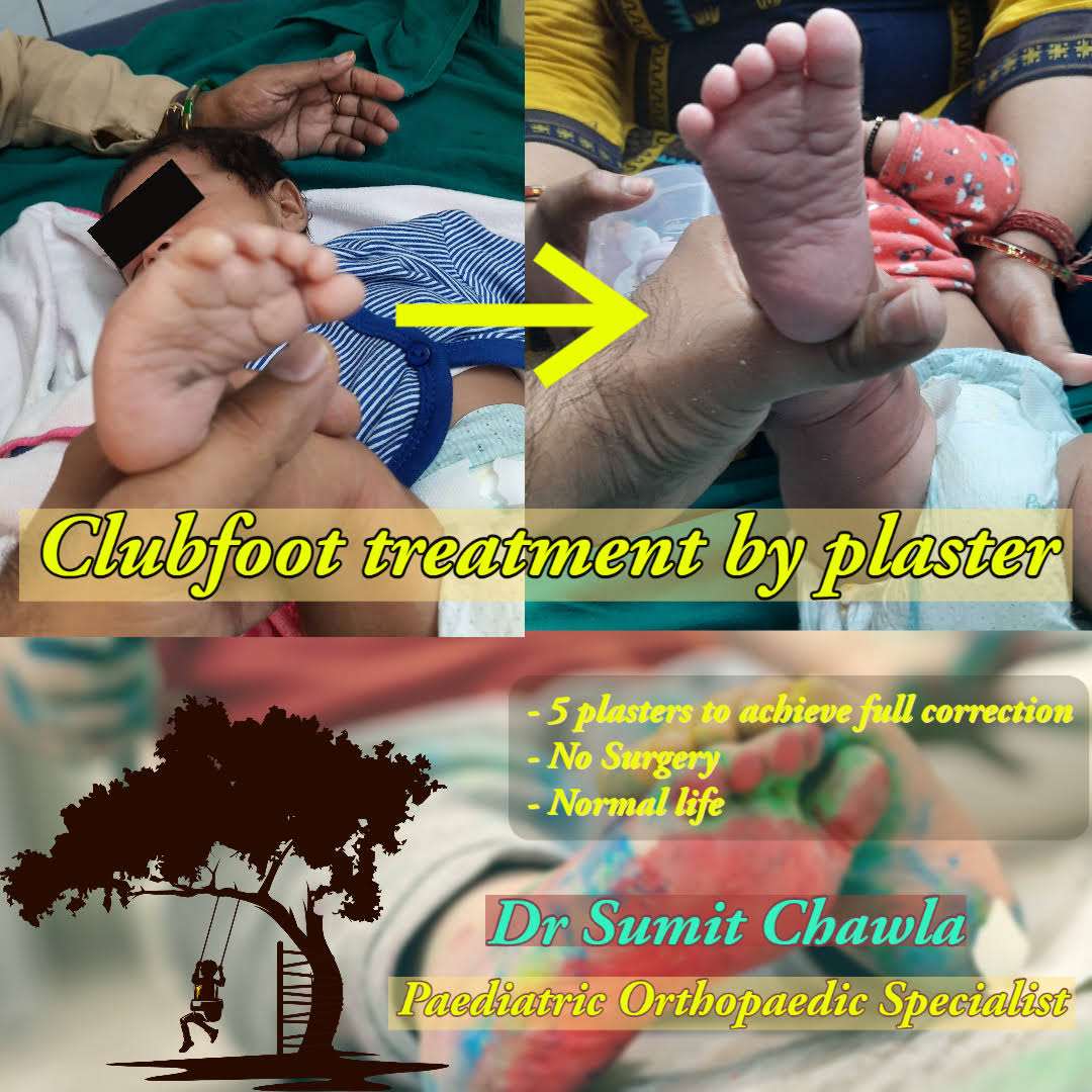 Clubfoot product image