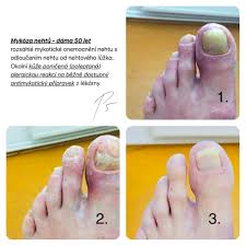 Image result for mykoza nehtů