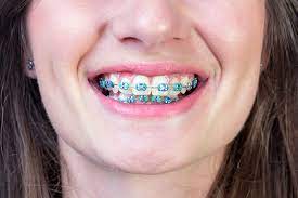 That is, white spots or streaks where the minerals of the enamel are altered and this is most visible after all the orthodontic treatment is finished and the orthodontic brackets are removed. What Colour Braces Make Your Teeth Look Whiter Evolution Orthodontics