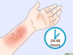 How To Get Rid Of Poison Ivy Rashes Poison Ivy Rash Poison Ivy Remedies Itch Poison Ivy Treatment