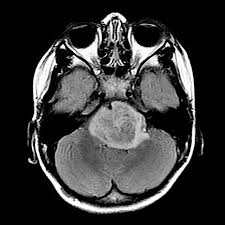 Hero images / getty images how to tell your child. Study Offers New Clues For Treating Brain Cancer In Children Stat