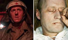 How does chernobyl compare to the recent fukushima disaster? Chernobyl In Pictures The Shocking Extent Of Radiation Burns And The Haunting Images World News Express Co Uk