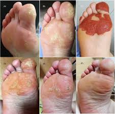 Assists in eliminating all strains of dog warts common to dogs, without the pain. Successful Treatment Of Plantar Warts Using Topical Zijinding A Traditional Chinese Medicine Preparation A Case Series Zhao 2020 Journal Of Cosmetic Dermatology Wiley Online Library