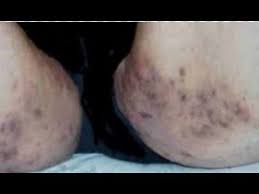 By removing the dead skin cells on the outer layer of your skin, brighter and cleaner skin is revealed. Get Rid Of Dark Inner Thighs Lighten Your Inner Thighs Youtube
