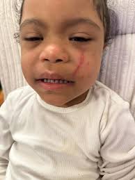 My daughter, 4, came home from nursery with huge bruises & blood