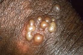 Image result for genital herpes