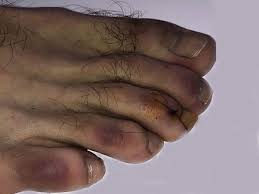 These may occur with or without respiratory symptoms. More Symptoms Of Coronavirus Covid Toes Skin Rashes