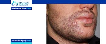 متى تختفي اثار زراعة الذقن اضرار زراعة الذقن اضرار زراعة شعر اللحية مخاطر زراعة الذقن