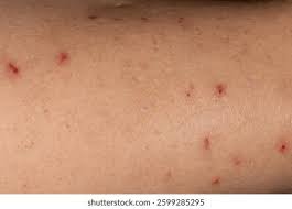 Image result for Neurotic Excoriation