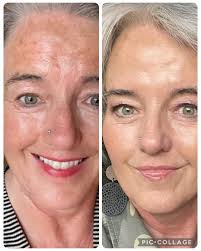 Joyome skincare results in just 3 weeks