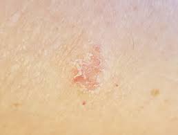 We did not find results for: Discoid Eczema Dermnet Nz