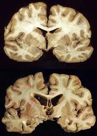 Not only did nearly 40 percent of the schizophrenia patients display relatively normal gray matter volumes, but this large minority actually. Gross Pathology Of Cte Top Coronal Section Of A Normal Human Brain Download Scientific Diagram