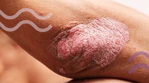 Image result for psoriasis