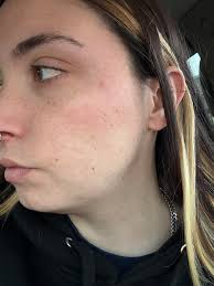 Tips for getting rid of acne with dry skin