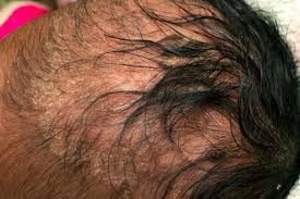 Image result for white scabs on the head in children