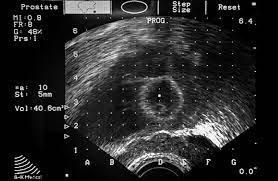 The earlier the detection of prostate cancer, the better the patient's chance of survival is. Diagnostic Accuracy Of Multi Parametric Mri And Transrectal Ultrasound Guided Biopsy In Prostate Cancer The Lancet
