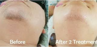 Do not bathe the area with very hot water until it has healed. Laser Hair Removal Microneedling Skin Care Treatment Laser Gals Skin Studio Yuma Az 85365