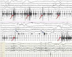 Image result for REM Sleep Behavior Disorder