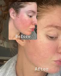 If you're still dealing with breakouts, this is your sign to try SUPER  CLEAR Verified Review : “My daughter has been