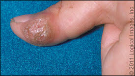 Choi y, kim do h, jin sy, lee. Treatment Of Nongenital Cutaneous Warts American Family Physician