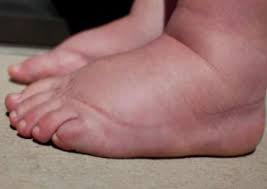 Comment Lutter Contre La Retention D Eau Astuces De Grand Mere Retention D Eau Pied Gonfle Remedes Pour Les Pieds