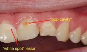Can you do it online or do you have to visit a passport agency? Tooth Filling Procedure Cost Cavity Filling Types Nearby Dental